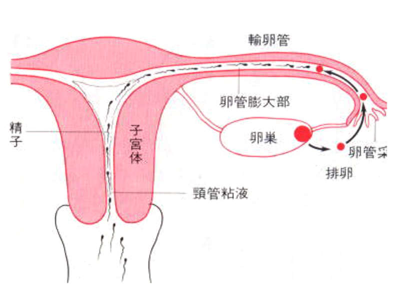 输卵管堵塞：现代女性健康的隐形杀手