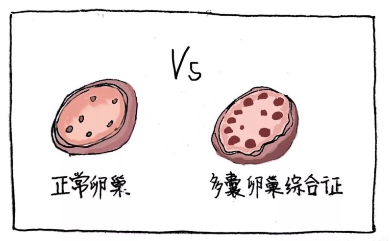 多囊卵巢综合征